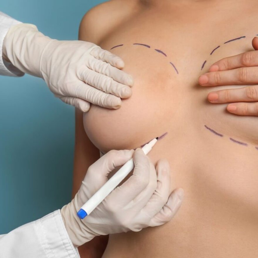 Breast Cosmetic Surgery