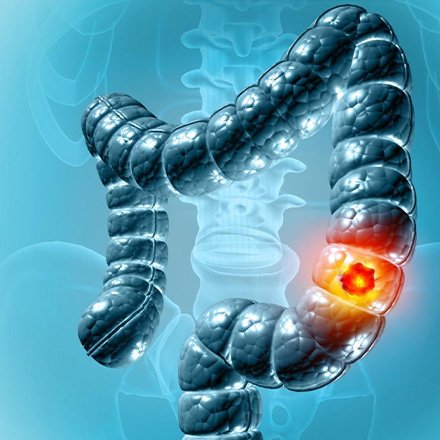 Preventive Gastro Care