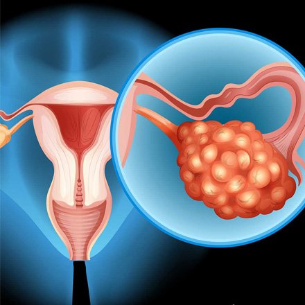 Ovarian Cyst Management