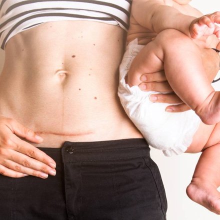 Previous C Section Pregnancy Care