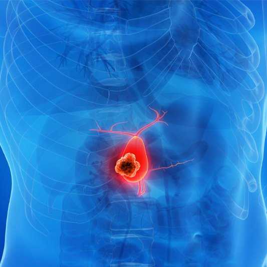 Cancer Treatment Approach at Optimus Hospital