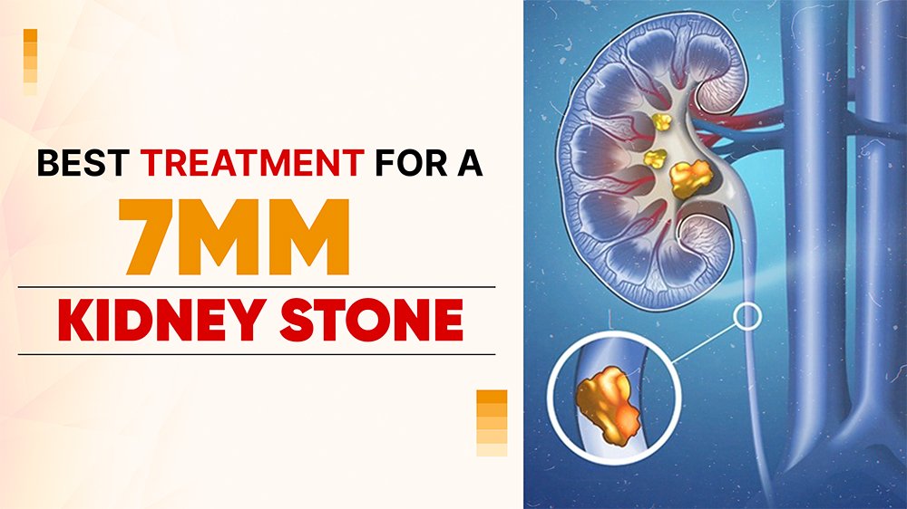 Best Treatment for a 7mm Kidney Stone