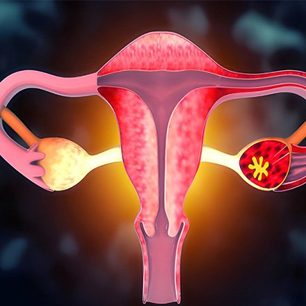 Ovulation Disorder Treatment