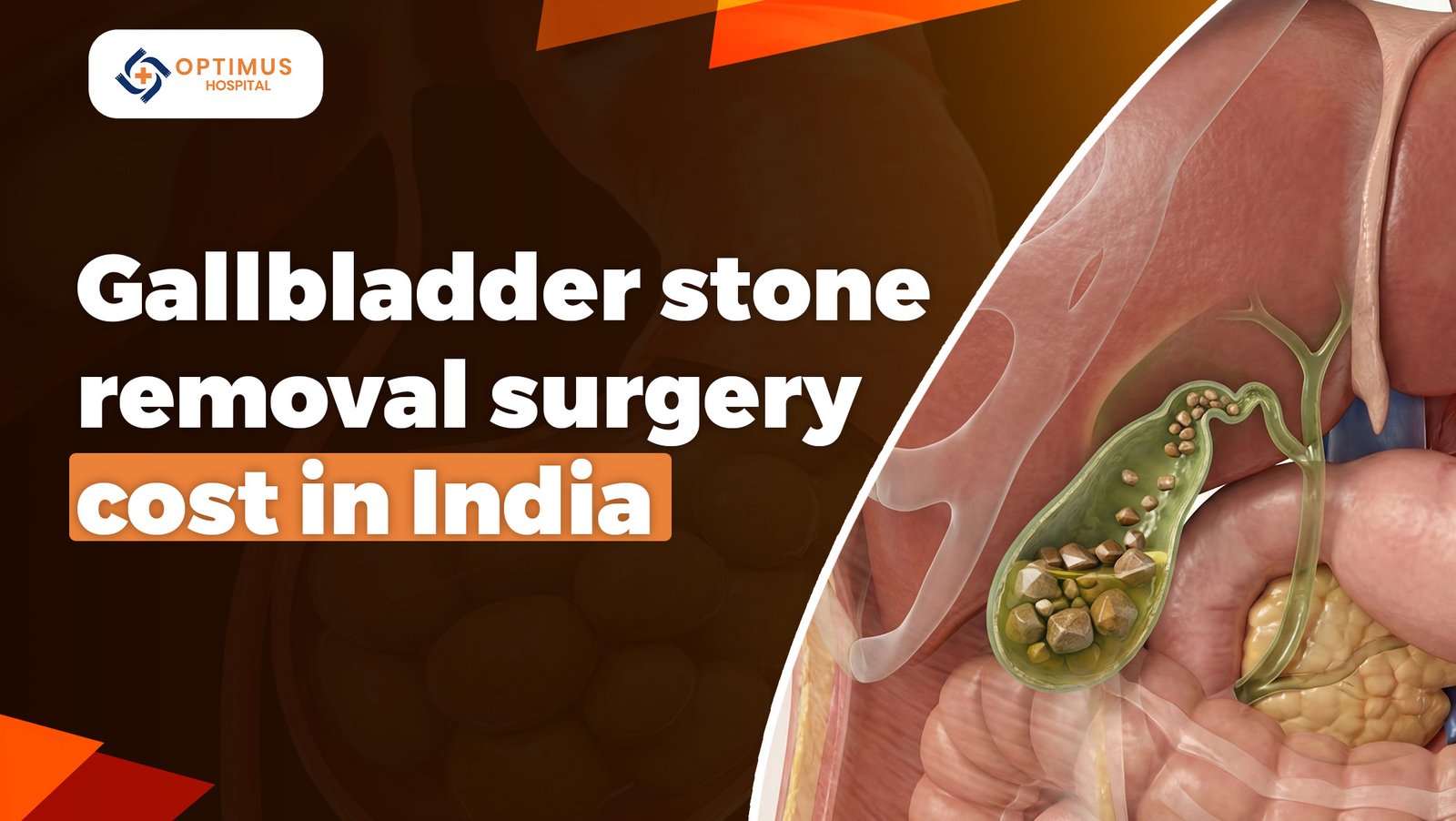 Gallbladder Stone Removal Surgery Cost in India
