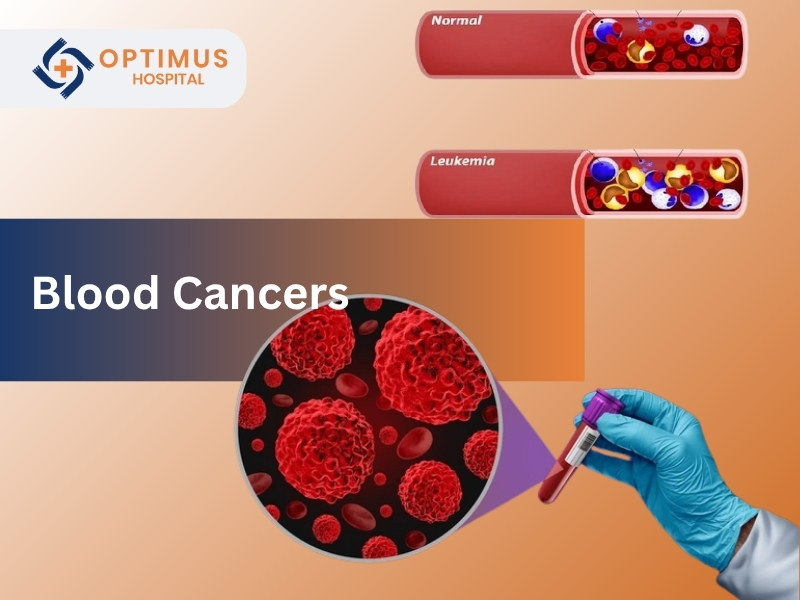 "Blood cancer illustration with normal and leukemia blood samples at Optimus Hospital in Gurgaon"